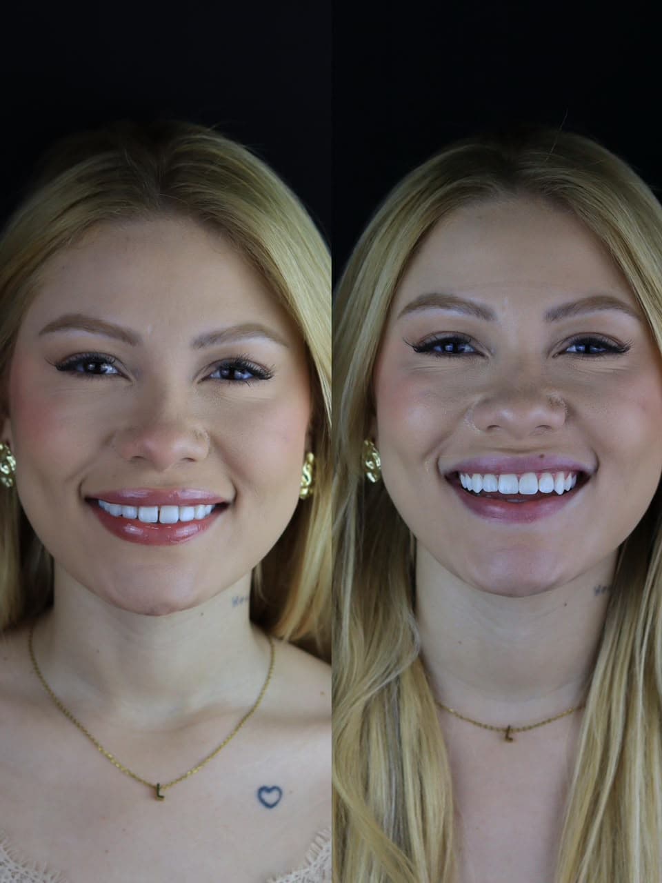 Antes e depois de tratamento estético realizado pelo Dr. Gabriel Wanderley